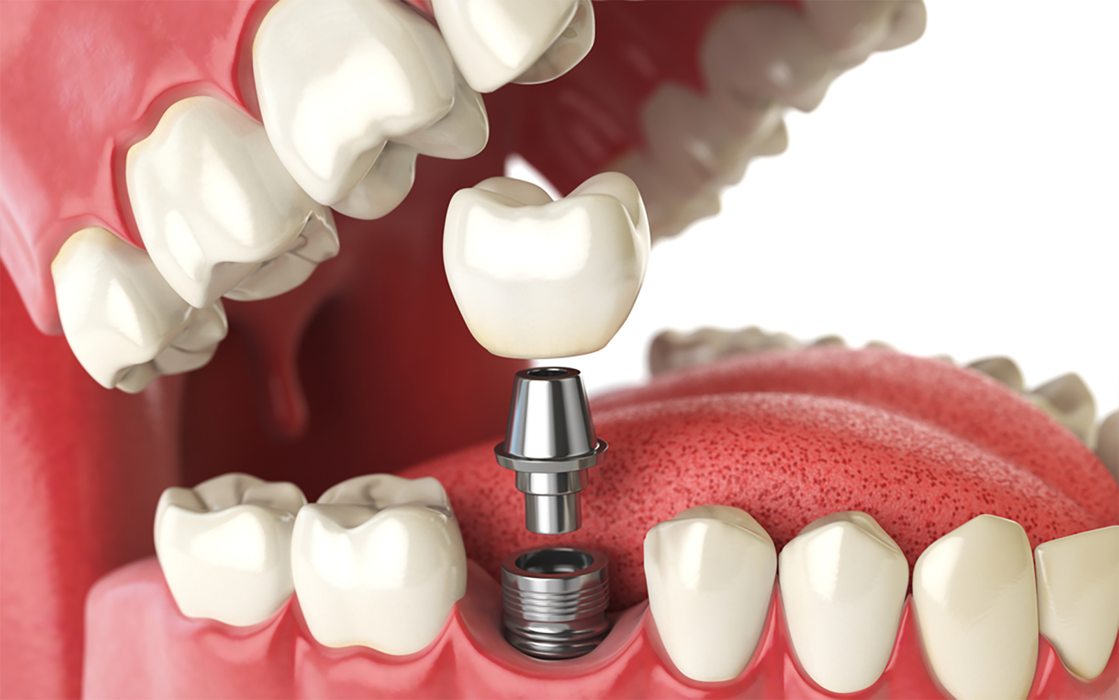 Pioneering Pain-Free Procedures: The New Era of Dental Implants