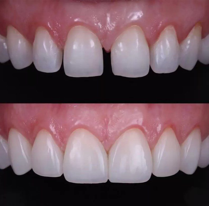 Why Composite Bonding Requires Less Tooth Preparation Than Traditional Cosmetic Treatments